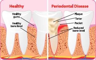 Healthy and Diseased Teeth and Gums