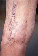 Nutraceutical Treatment for Varicose Veins