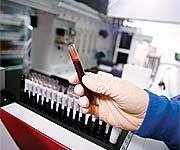 Life-Saving Advances in Prostate Cancer Testing