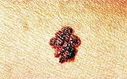 Melanoma Can Strike Other Areas of Body