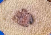 Identifying Melanoma