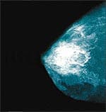 Vitamin D Prolongs Breast Cancer Survival