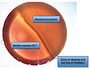 Aphthous Stomatitis (Canker Sores)