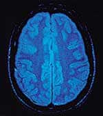 Progesterone Safe, Effective in Human Trials for Traumatic Brain Injury