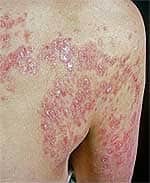 Who Gets Psoriasis?