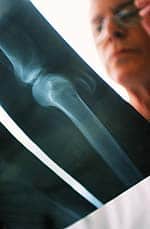 Calcium and Vitamin D Supplementation Reduces Fracture Risk Regardless of Age, Gender 