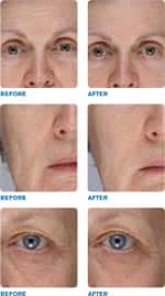 Does Exfoliation Really Work?