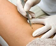 Dermatologist removing mole
