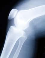 Osteoarthritis: The Scourge of Aging Individuals