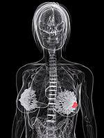 Nutrients to Quell NF-kB’s Inflammatory, Pro-Cancer Effects