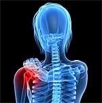 Krill Oil Optimizes Multimodal Arthritis Control