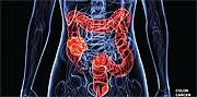 Colon Cancer