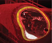 Vitamin K2 Keeps Calcium Out Of Arteries