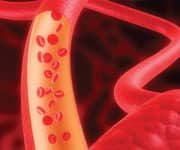 A similar study done in patients with existing coronary artery disease