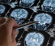 High-Normal Blood Sugar Could Adversely Impact the Brain