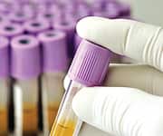 PSA: Pestilence or Promise?