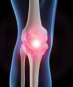 Halt the Auto-Immune Attack of Arthritis
