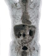 Assigning a higher stage to a known cancer