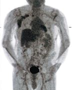 Assigning a lower stage to a known cancer