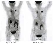 Monitoring a patient’s unfavorable response to therapy