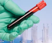 Low Testosterone Increases Prostate Cancer Risk