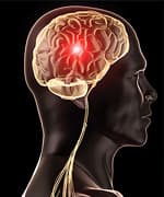 The Link Between Excess Iron and Brain Degeneration