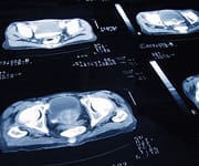 Multiple Dangers of Excess Arachidonic Acid