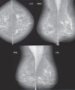 Advanced Breast Cancer Treatment: Hope Is On The Horizon