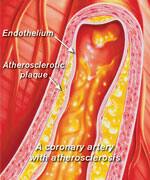 Illustration of branches of a coronary artery on the surface of the heart