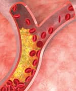 Cholesterol in artery