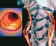 3-D spiral CT scan- angiogram- carotid atherosclerosis