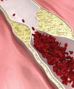 Arteries Clog as We Age