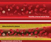 Atherosclerotic plaque