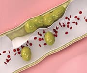 Published, peer-reviewed research demonstrates L-carnitine prevents the progression of atherosclerotic lesions.
