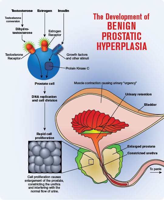 The Development of Benign ProsTaTic bPH with a HyPerPlasia