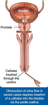 Obstruction of urine flow