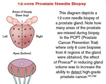 12-core Prostate Needle Biopsy