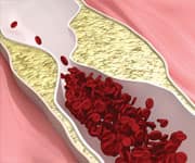 Atherosclerosis disease - Clogged Arteries (Arterial Plaque)