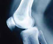 Bone Loss Prevention