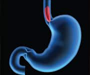 Guard Against Esophageal Cancer