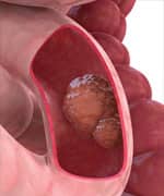 Probiotics Protect Against Chronic Diseases