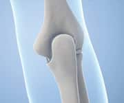 Reduced Vitamin D Levels Correlate With Greater Risk Of Fracture Among Women