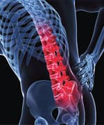 Boswellia Versus NSAIDs