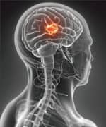 Boswellia Extracts Help Manage Brain Tumors