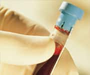 Reduced Vitamin B12 Levels Linked To Increased Progression Of White Matter Lesions