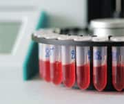 Elevated Glucose Levels Risk Factor For Dementia