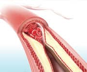 Four-Step Creation Of Harmful Plaque