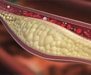 Atherosclerotic plaque