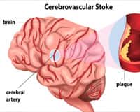 Stroke Signs And Symptoms