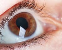 Metformin May Reduce Glaucoma Risk